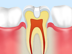 歯を削らずに虫歯を治す方法「ドックスベストセメント」