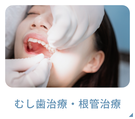 むし歯治療・根管治療